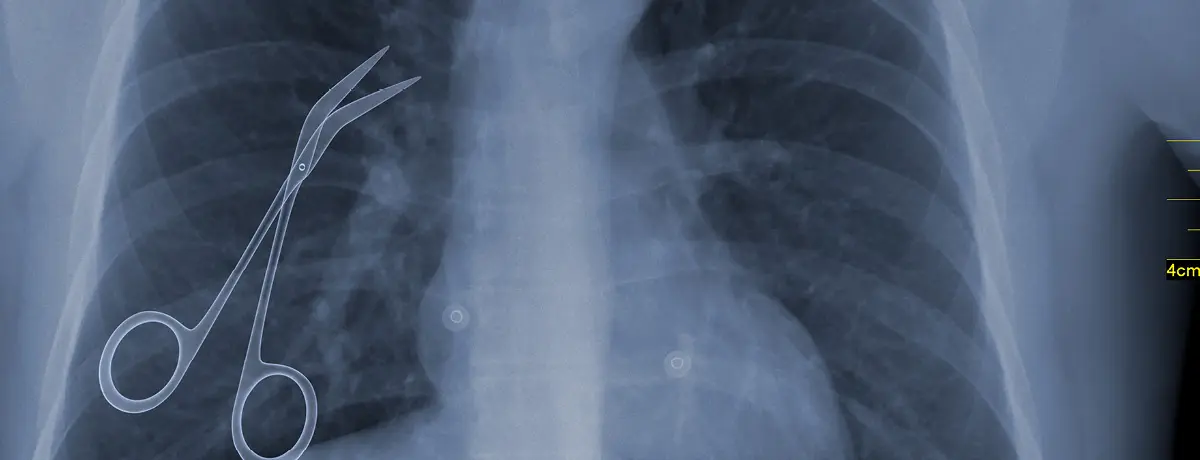 X-ray image of a patient's chest showing surgical scissors inadvertently