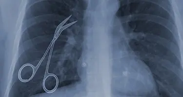 X-ray image of a patient's chest showing surgical scissors inadvertently