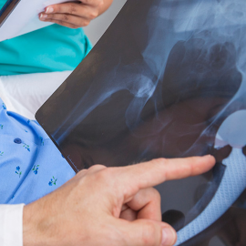 The Dangers of All-Metal Hip Implants